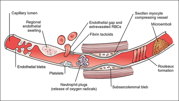 Fig_2_Reperfusion_injury_2-0001.png