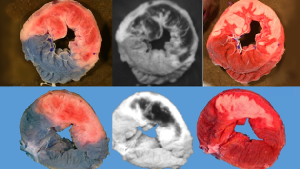 Fig_1_Ischemic_risk_zone_and_infarct-0001.png